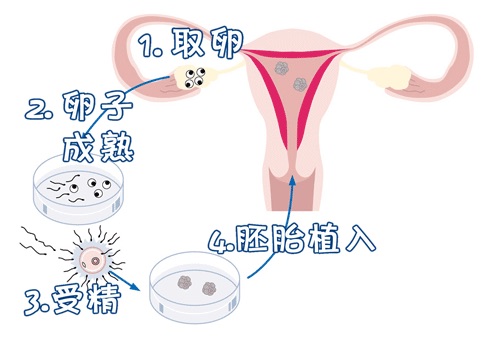 正规有偿捐卵